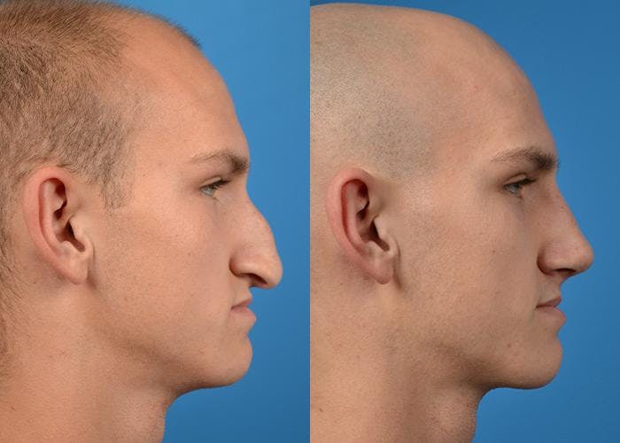 Male Rhinoplasty Before & After Gallery - Patient 122406362 - Image 1