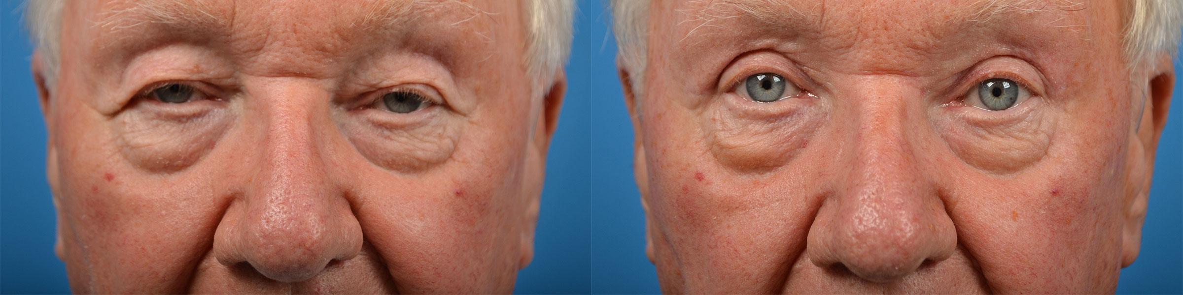 Male Eyelid Surgery Before & After Gallery - Patient 122406361 - Image 1