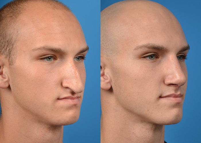 Male Rhinoplasty Before & After Gallery - Patient 122406362 - Image 2