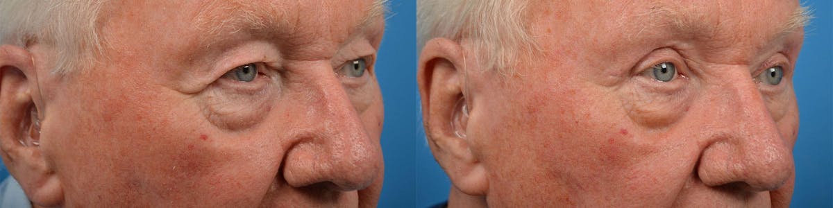 Male Eyelid Surgery Before & After Gallery - Patient 122406361 - Image 2