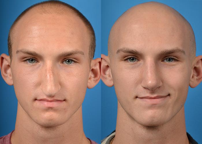 Male Rhinoplasty Before & After Gallery - Patient 122406362 - Image 3