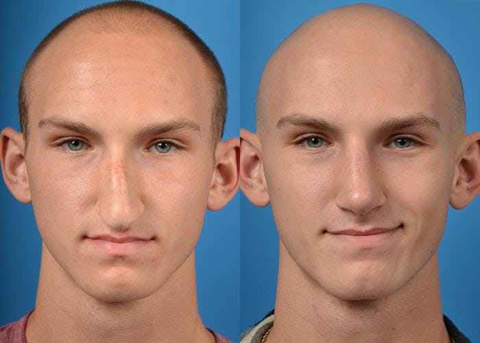 Male Rhinoplasty Before & After Gallery - Patient 122406362 - Image 3