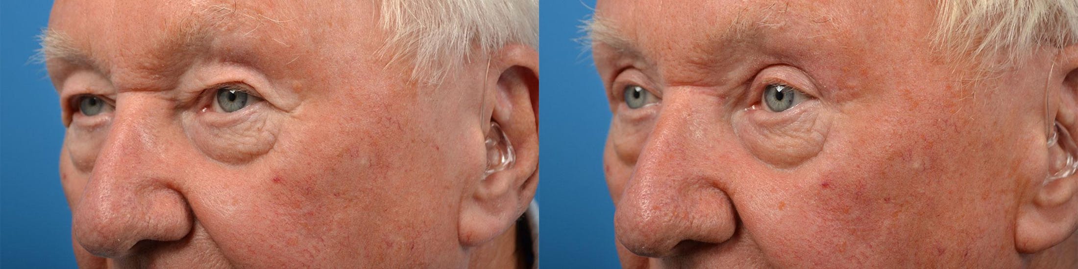 Male Eyelid Surgery Before & After Gallery - Patient 122406361 - Image 3