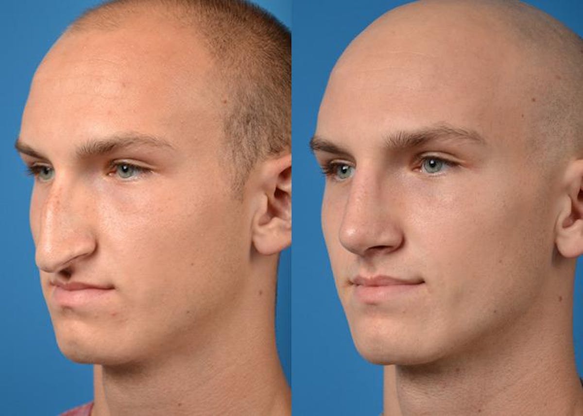 Male Rhinoplasty Before & After Gallery - Patient 122406362 - Image 4