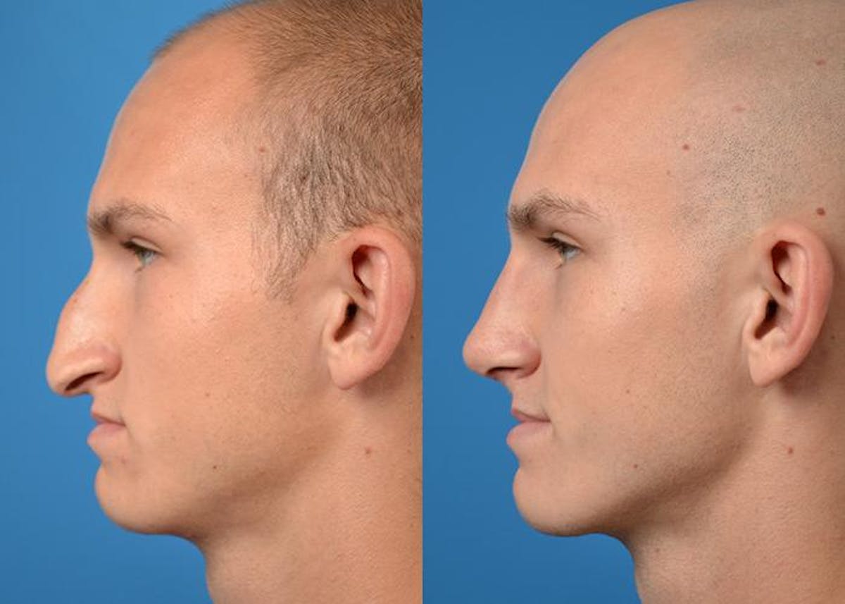 Male Rhinoplasty Before & After Gallery - Patient 122406362 - Image 5
