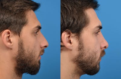 Male Rhinoplasty Before & After Gallery - Patient 122406365 - Image 1