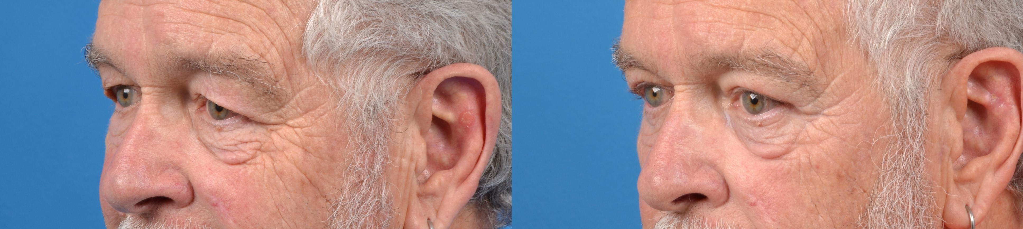 Male Eyelid Surgery Before & After Gallery - Patient 122406363 - Image 2