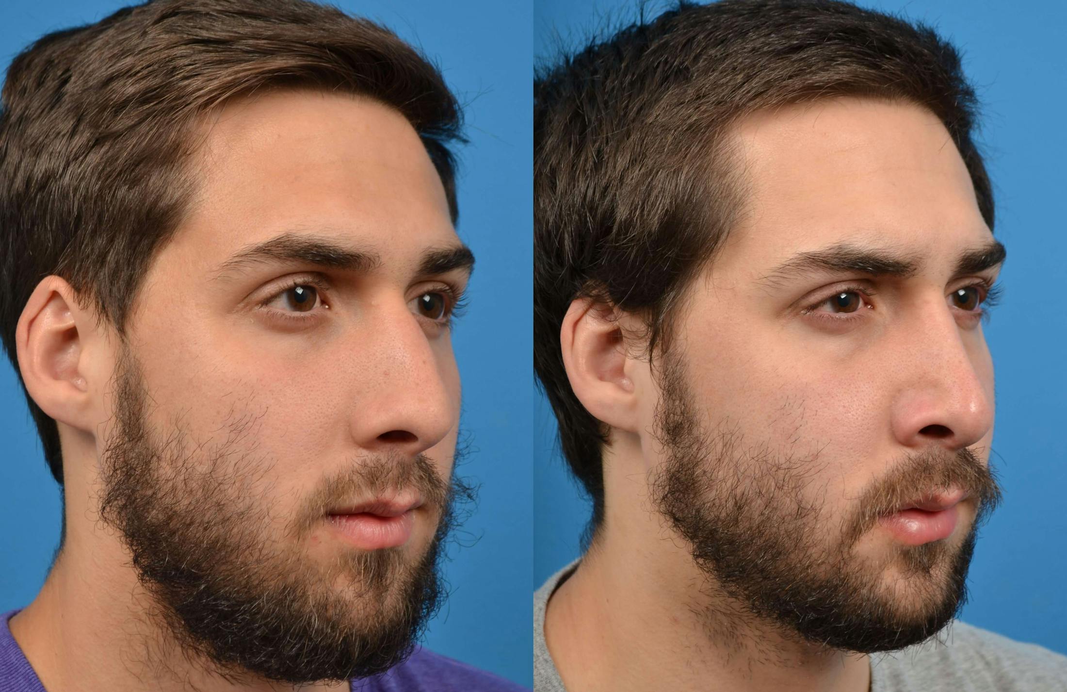 Male Rhinoplasty Before & After Gallery - Patient 122406365 - Image 2
