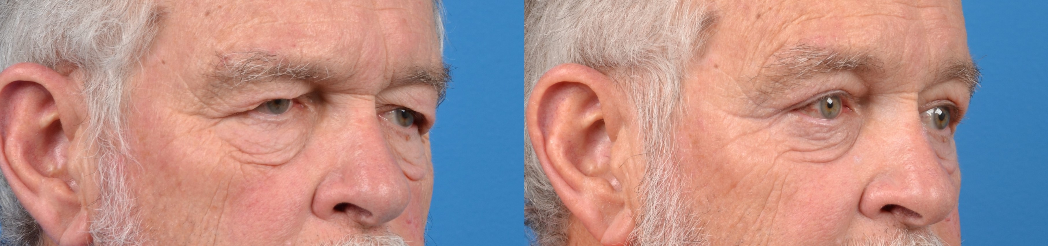 Male Eyelid Surgery Before & After Gallery - Patient 122406363 - Image 3