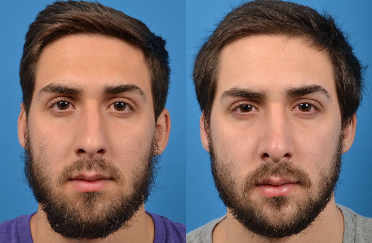 Male Rhinoplasty Before & After Gallery - Patient 122406365 - Image 3