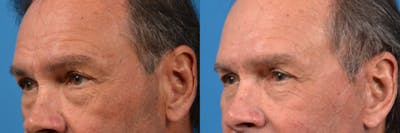 Male Eyelid Surgery Before & After Gallery - Patient 122406364 - Image 1
