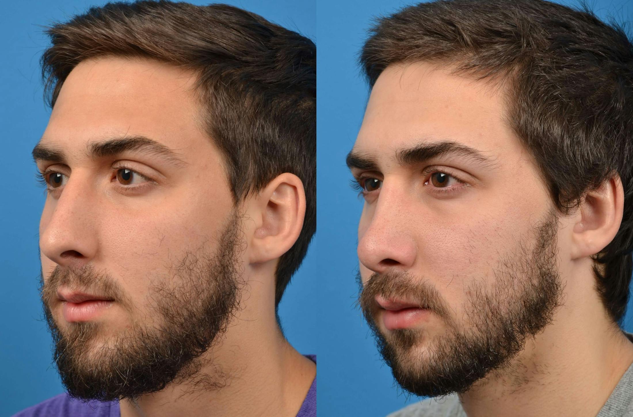 Male Rhinoplasty Before & After Gallery - Patient 122406365 - Image 4