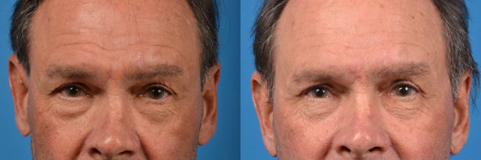 Male Eyelid Surgery Before & After Gallery - Patient 122406364 - Image 2