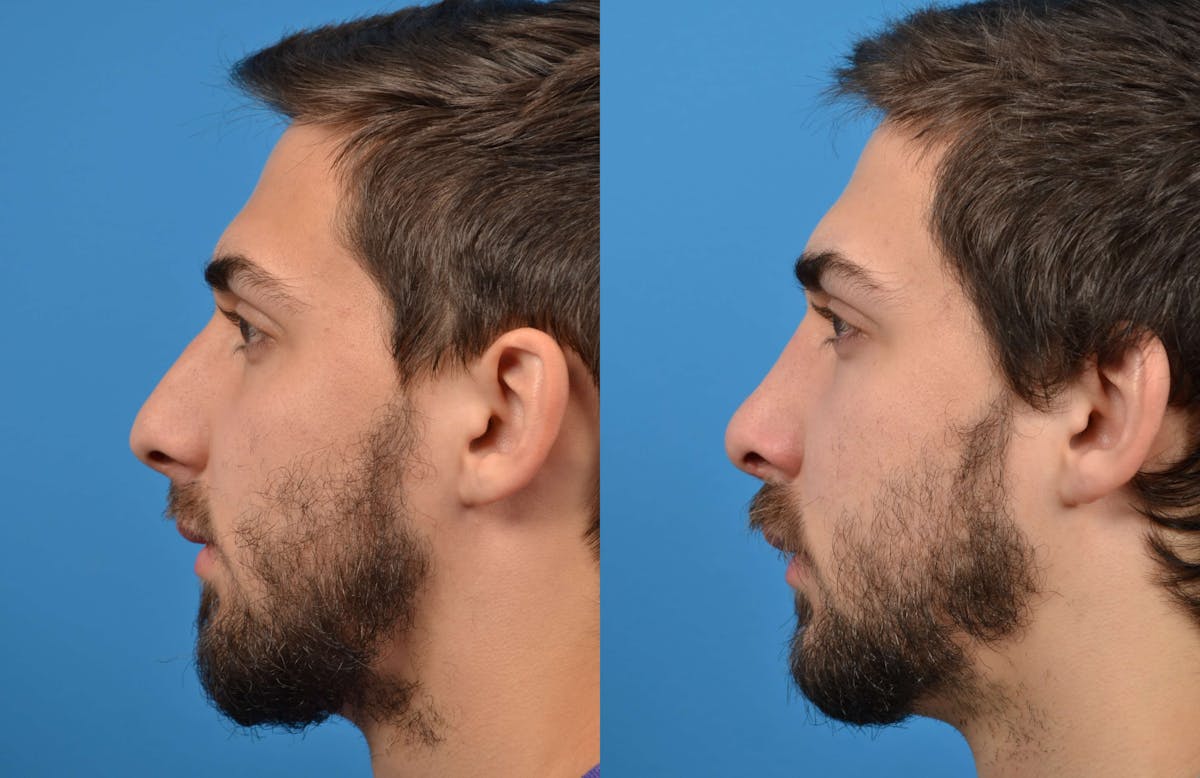 Male Rhinoplasty Before & After Gallery - Patient 122406365 - Image 5