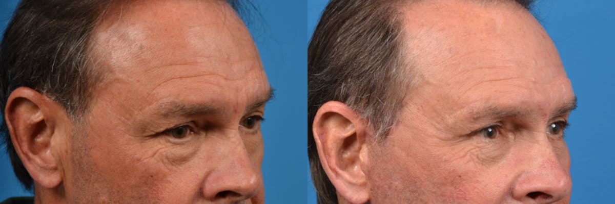 Male Eyelid Surgery Before & After Gallery - Patient 122406364 - Image 3