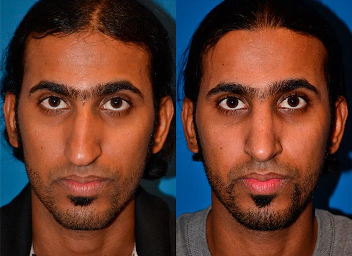 Male Rhinoplasty Before & After Gallery - Patient 122406368 - Image 1