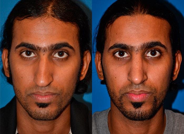 Rhinoplasty Before & After Gallery - Patient 142762939 - Image 1