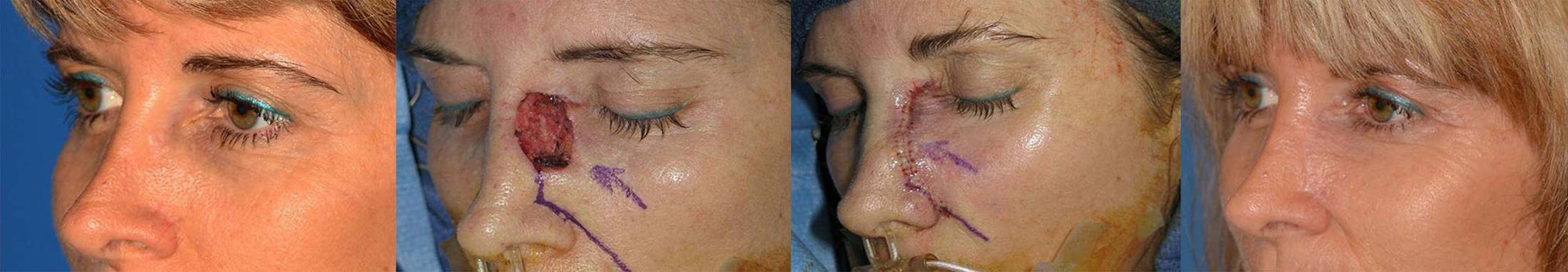 Mohs Surgery and Skin Cancer Before & After Gallery - Patient 122406366 - Image 1