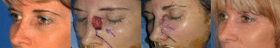 Mohs Surgery and Skin Cancer Before & After Gallery - Patient 122406366 - Image 1