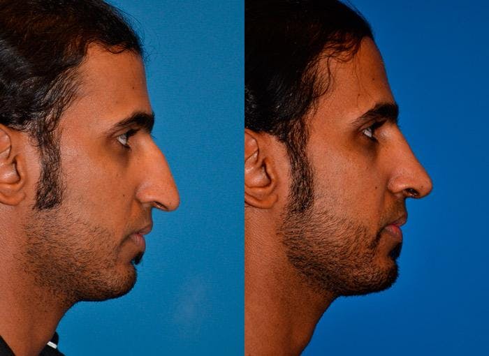 Rhinoplasty Before & After Gallery - Patient 142762939 - Image 2