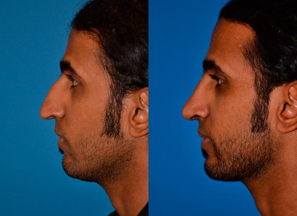 Rhinoplasty Before & After Gallery - Patient 142762939 - Image 3