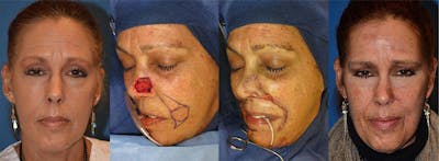 Mohs Surgery and Skin Cancer Before & After Gallery - Patient 122406369 - Image 1