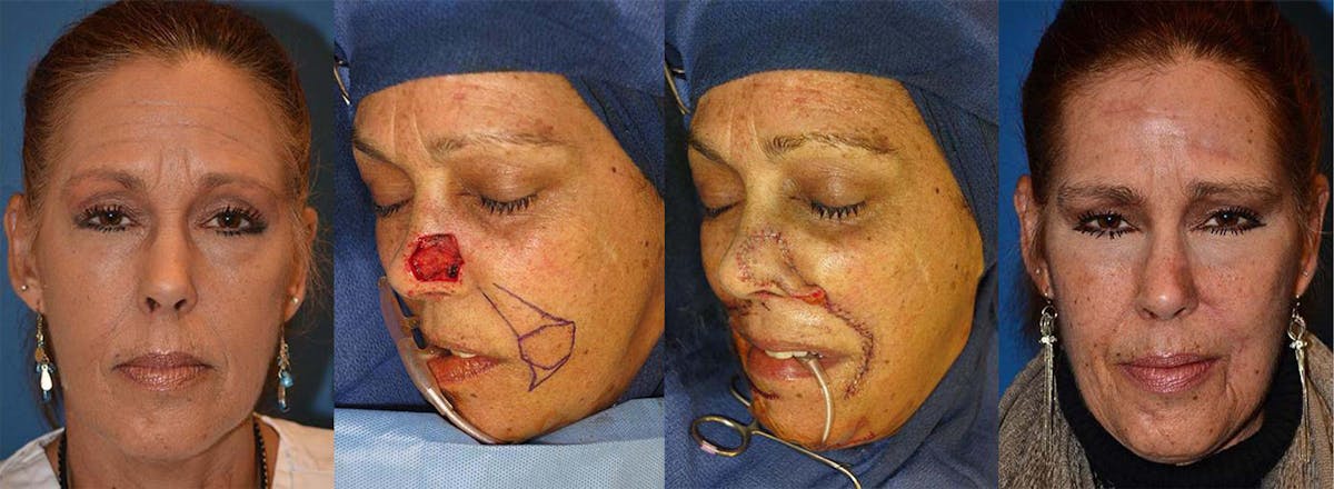 Mohs Surgery and Skin Cancer Before & After Gallery - Patient 122406369 - Image 1