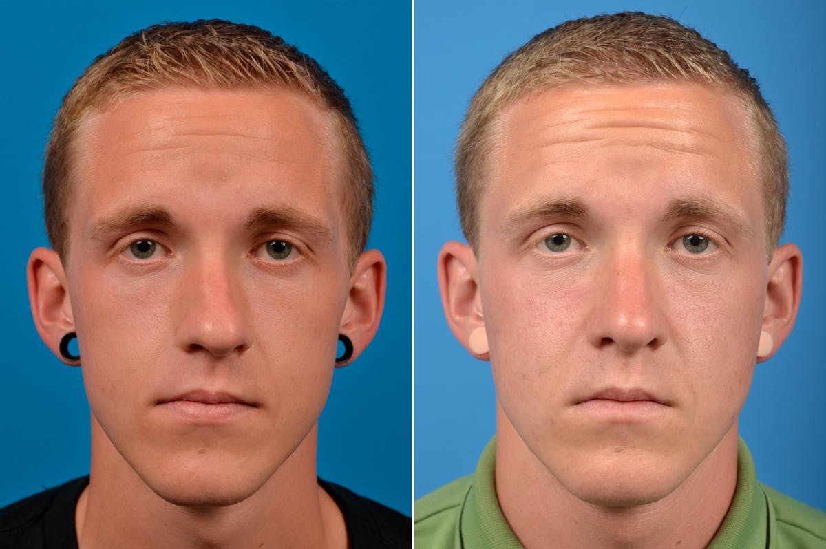 Male Rhinoplasty Before & After Gallery - Patient 122406372 - Image 1