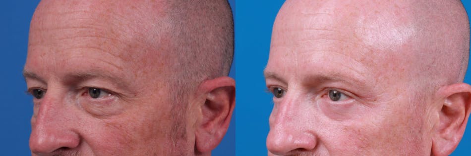 Male Eyelid Surgery Before & After Gallery - Patient 122406373 - Image 1
