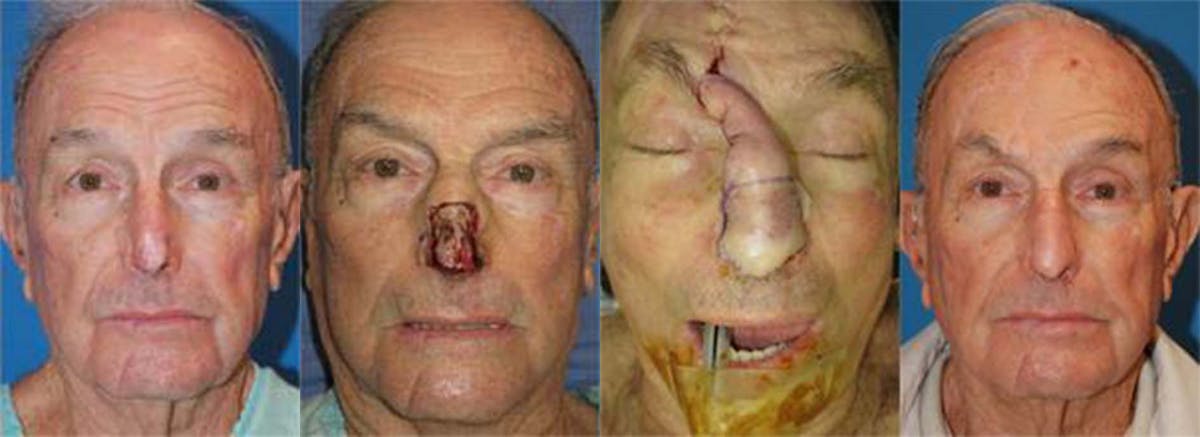 Mohs Surgery and Skin Cancer Before & After Gallery - Patient 122406370 - Image 1