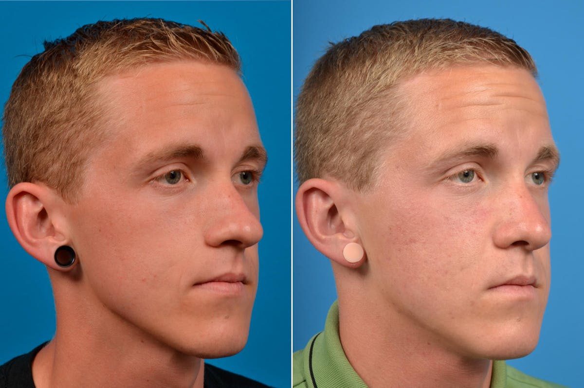 Male Rhinoplasty Before & After Gallery - Patient 122406372 - Image 2