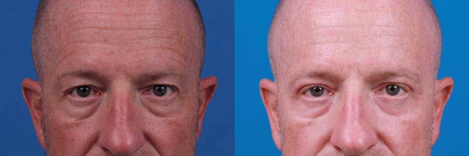 Male Eyelid Surgery Before & After Gallery - Patient 122406373 - Image 2