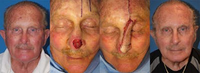 Mohs Surgery and Skin Cancer Before & After Gallery - Patient 122406371 - Image 1