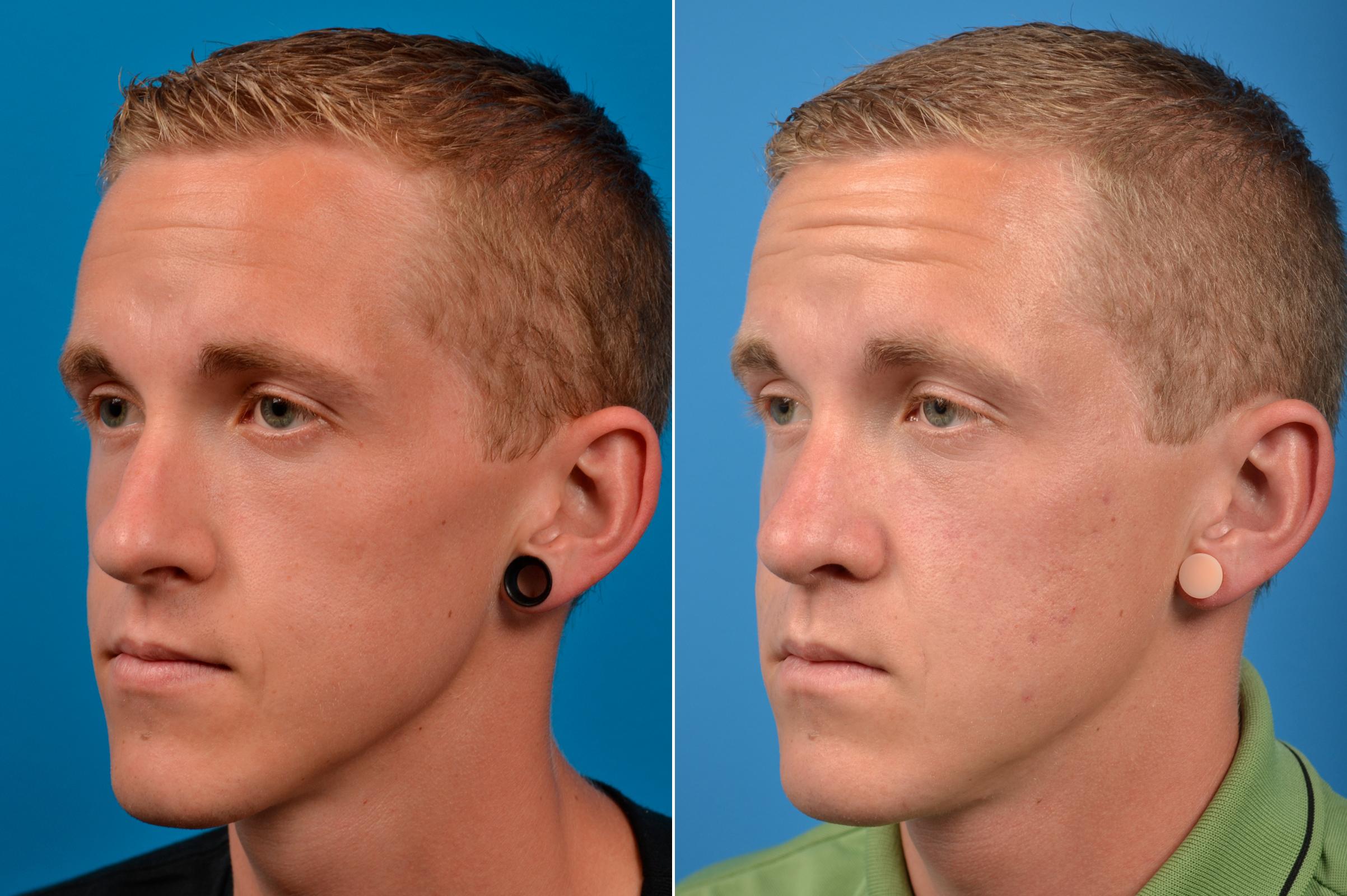 Male Rhinoplasty Before & After Gallery - Patient 122406372 - Image 3