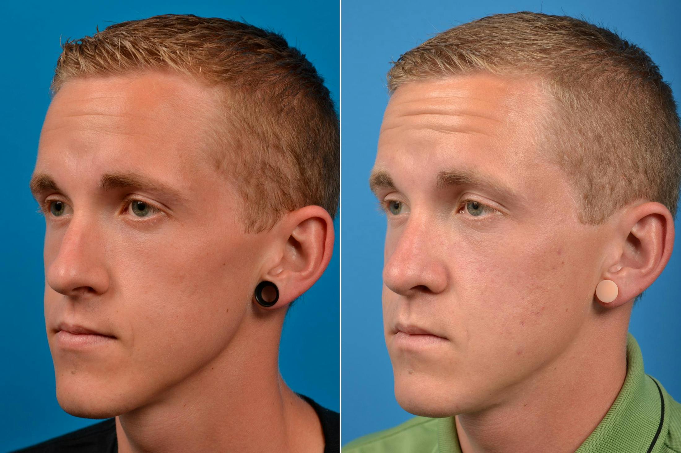 Rhinoplasty Before & After Gallery - Patient 142762941 - Image 3