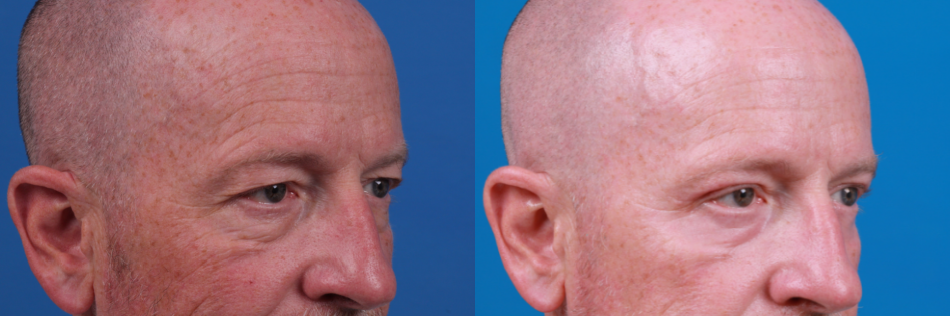 Male Eyelid Surgery Before & After Gallery - Patient 122406373 - Image 3