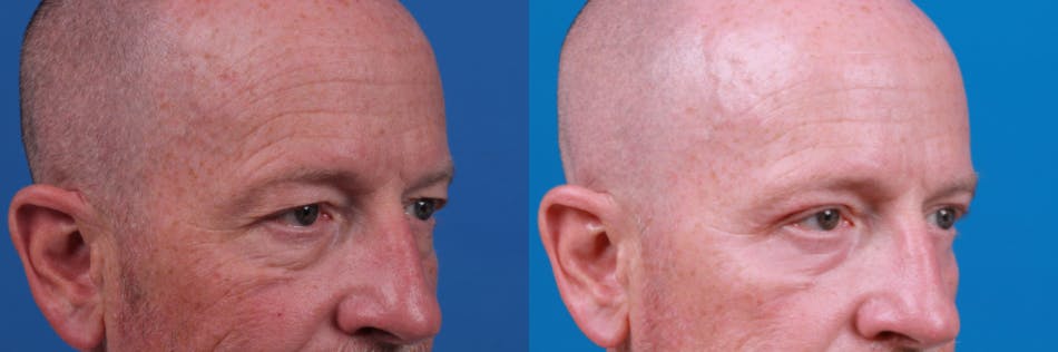 Male Eyelid Surgery Before & After Gallery - Patient 122406373 - Image 3