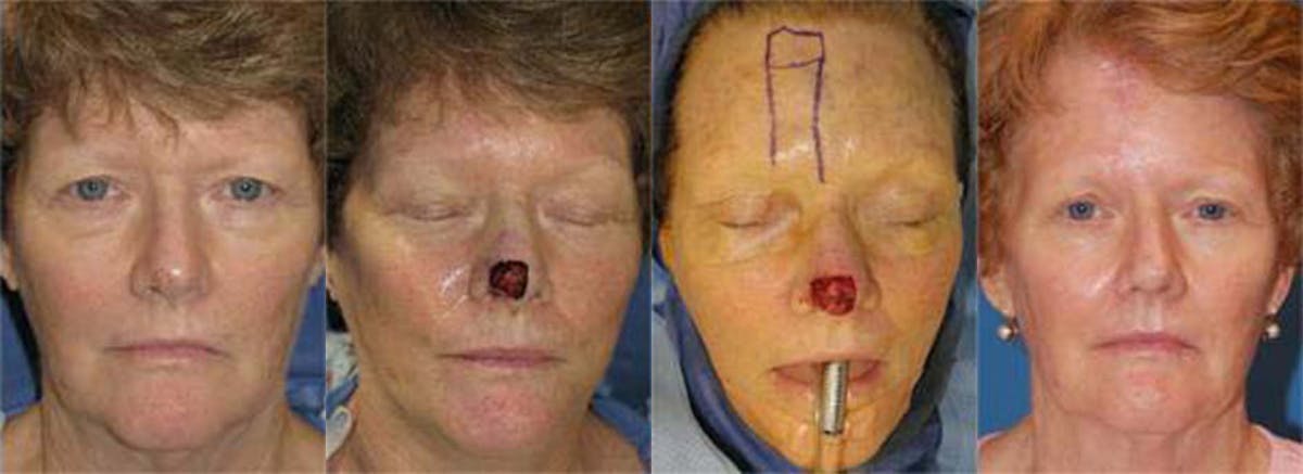 Mohs Surgery and Skin Cancer Before & After Gallery - Patient 122406374 - Image 1