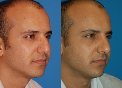 Rhinoplasty Before & After Gallery - Patient 142762985 - Image 1