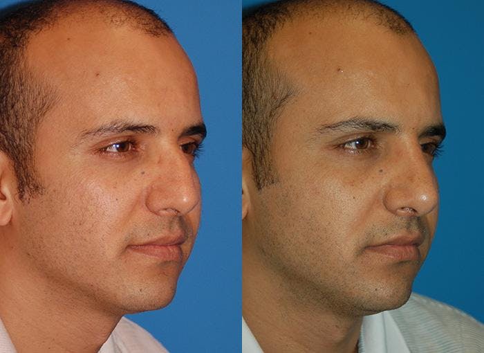 Male Rhinoplasty Before & After Gallery - Patient 122406378 - Image 1