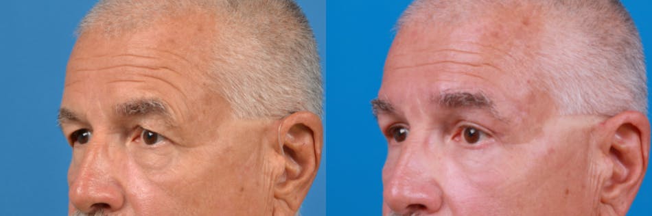 Male Eyelid Surgery Before & After Gallery - Patient 122406380 - Image 1