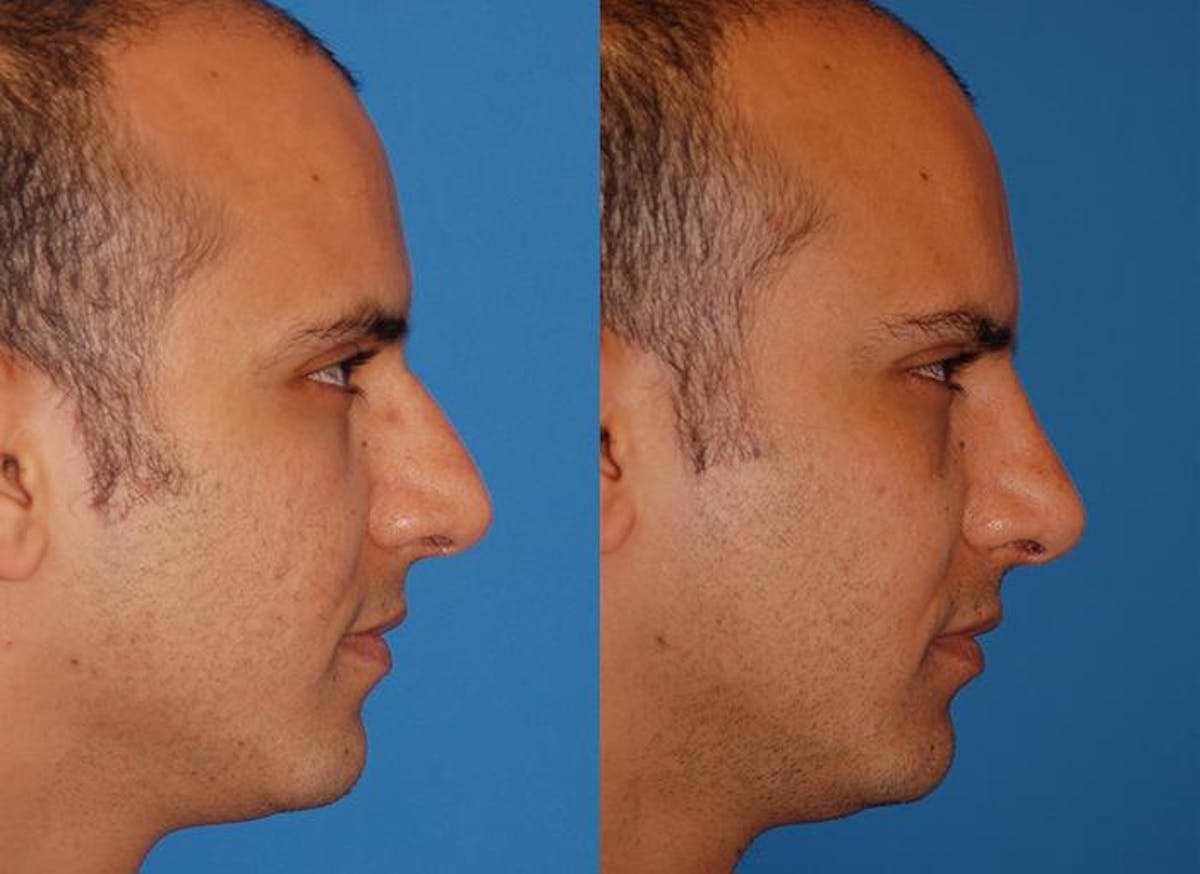 Male Rhinoplasty Before & After Gallery - Patient 122406378 - Image 2