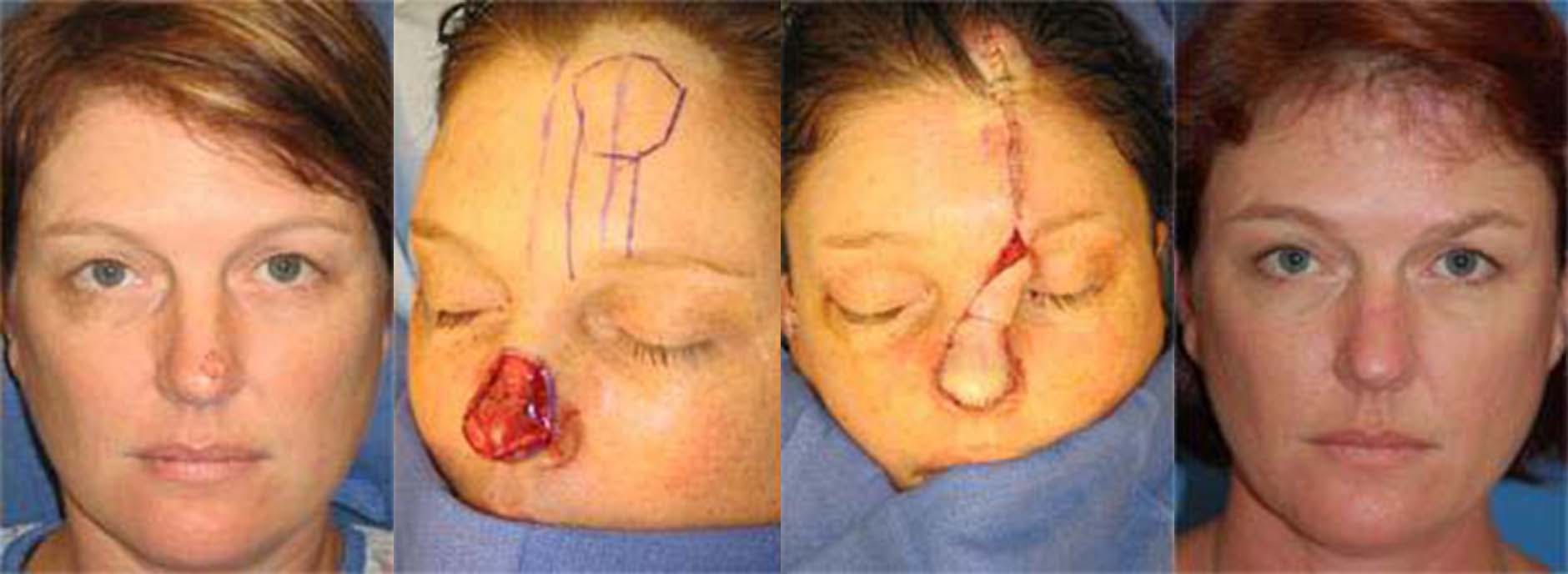 Mohs Surgery and Skin Cancer Before & After Gallery - Patient 122406377 - Image 1