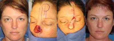 Mohs Surgery and Skin Cancer Before & After Gallery - Patient 122406377 - Image 1