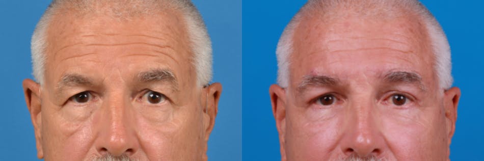 Male Eyelid Surgery Before & After Gallery - Patient 122406380 - Image 2