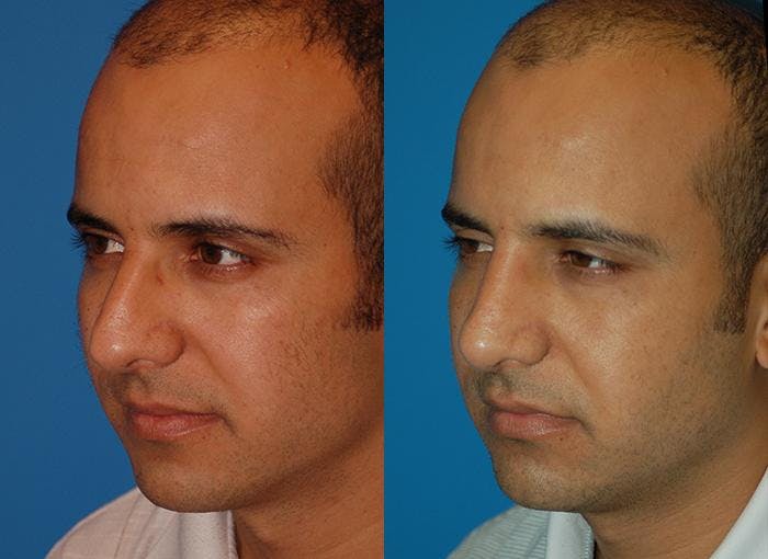 Rhinoplasty Before & After Gallery - Patient 142762985 - Image 3