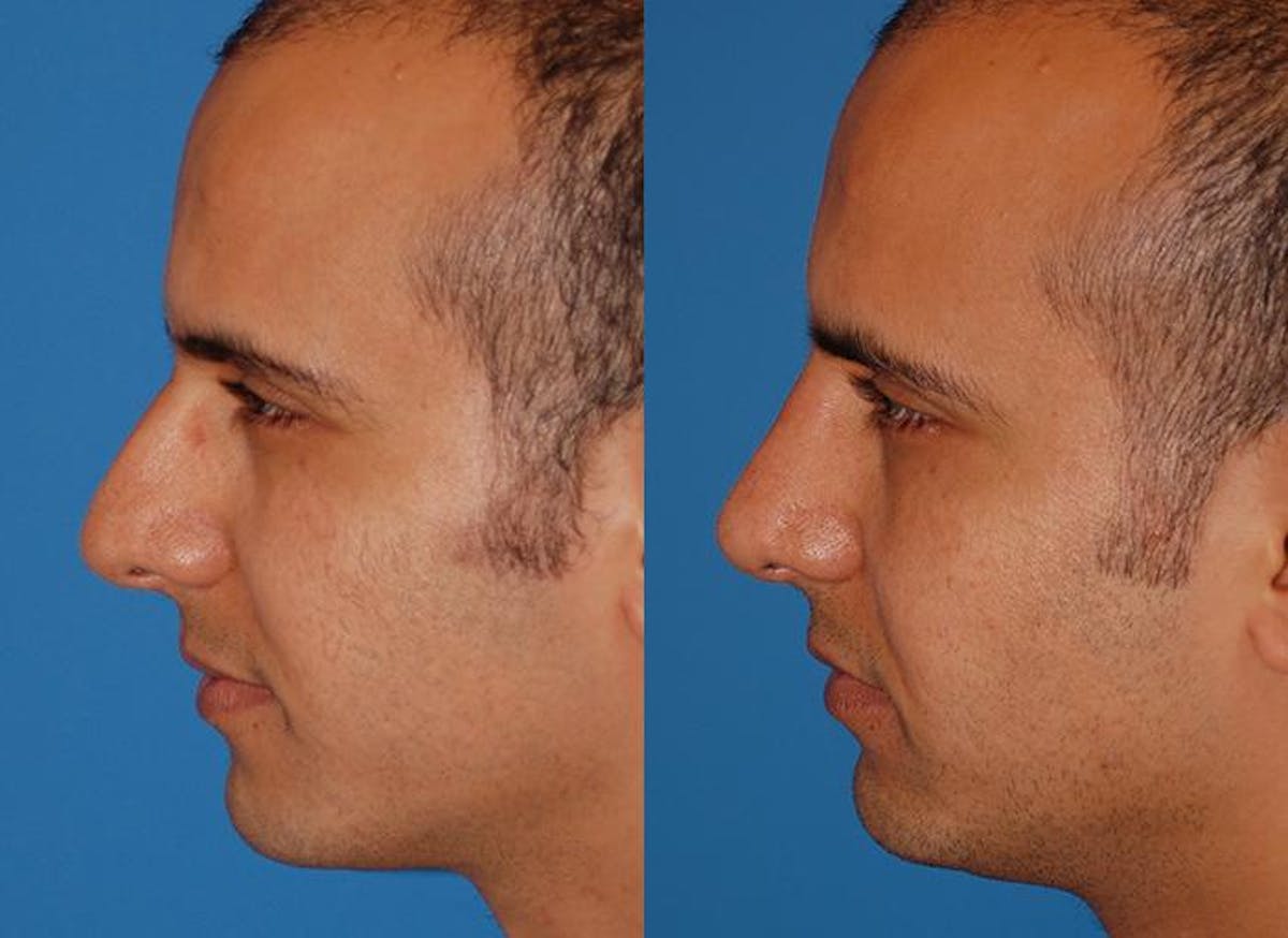 Male Rhinoplasty Before & After Gallery - Patient 122406378 - Image 4