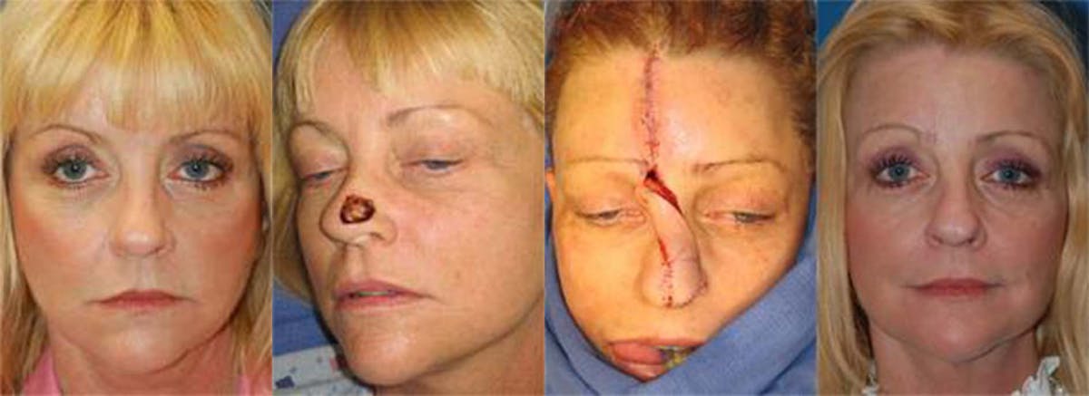 Mohs Surgery and Skin Cancer Before & After Gallery - Patient 122406379 - Image 1