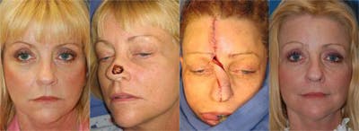 Mohs Surgery and Skin Cancer Before & After Gallery - Patient 122406379 - Image 1