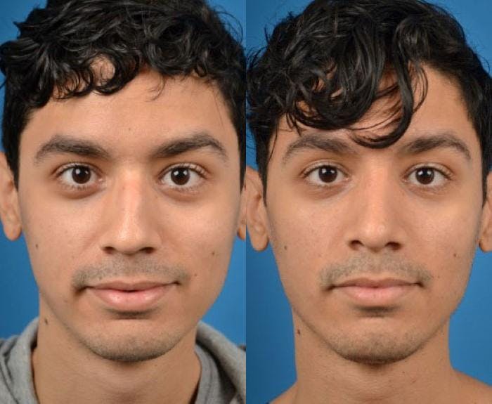 Male Rhinoplasty Before & After Gallery - Patient 122406384 - Image 1